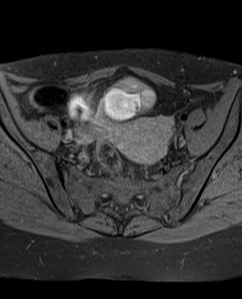 File:Adult granulosa cell tumor of the ovary (Radiopaedia 71581-81950 Axial T1 fat sat 11).jpg