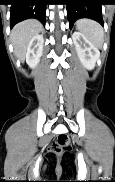 File:Agenesis of the gallbladder (Radiopaedia 55454-61905 A 39).jpg