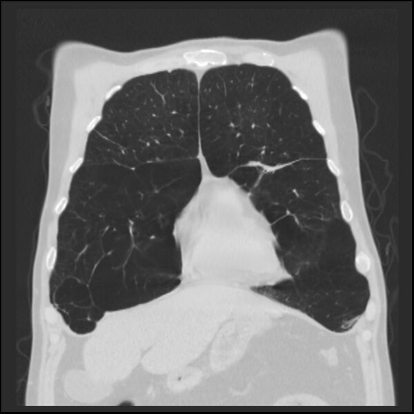 File:Alpha-1-antitrypsin deficiency (Radiopaedia 40993-43722 Coronal lung window 22).jpg