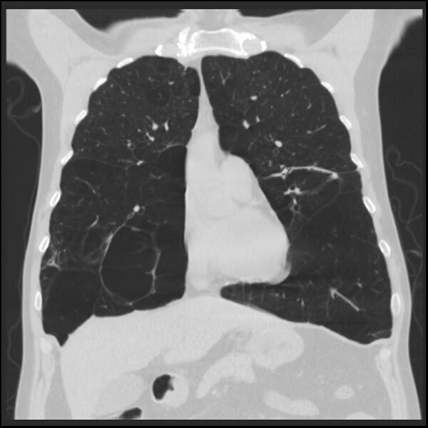 File:Alpha-1-antitrypsin deficiency (Radiopaedia 40993-43722 Coronal lung window 33).jpg