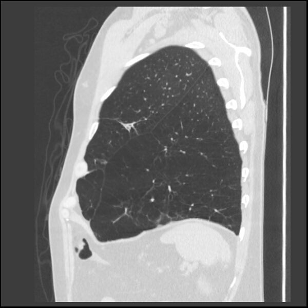 File:Alpha-1-antitrypsin deficiency (Radiopaedia 40993-43722 Sagittal lung window 48).jpg