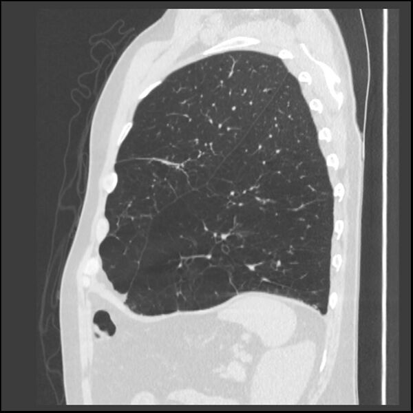 File:Alpha-1-antitrypsin deficiency (Radiopaedia 40993-43722 Sagittal lung window 59).jpg
