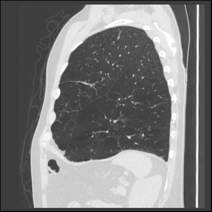 Alpha-1-antitrypsin deficiency (Radiopaedia 40993-43722 Sagittal lung window 59).jpg