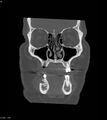 Ameloblastoma (Radiopaedia 18115-17901 Axial bone window 22).jpg