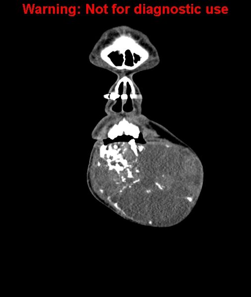 File:Ameloblastoma (Radiopaedia 33126-34164 D 11).jpg