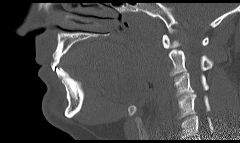 File:Ameloblastoma (Radiopaedia 33677-34806 Sagittal bone window 36).png