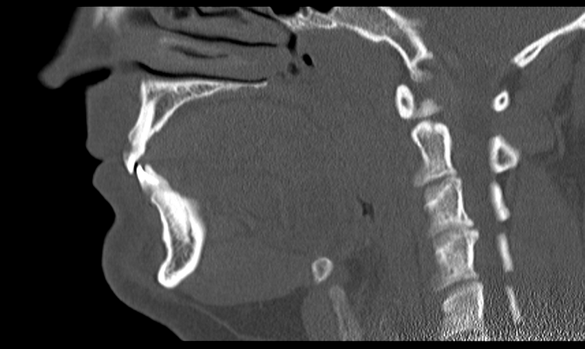 Ameloblastoma (Radiopaedia 33677-34806 Sagittal bone window 36).png