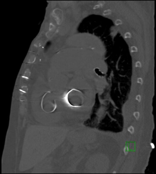 File:Amiodarone deposition in the liver (Radiopaedia 77587-89780 Sagittal bone window 41).jpg