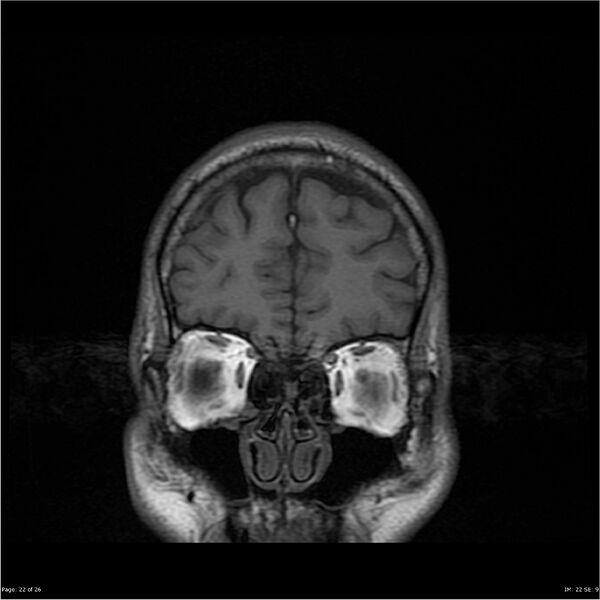 File:Amnestic syndrome secondary to hypoxic brain injury (Radiopaedia 24743-25004 B 22).jpg