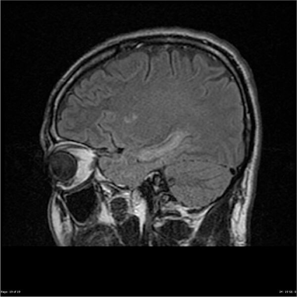 File:Amnestic syndrome secondary to hypoxic brain injury (Radiopaedia 24743-25004 D 19).jpg