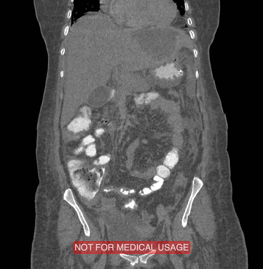 Amoebic enterocolitis with liver abscess (Radiopaedia 35100-36609 B 72).jpg