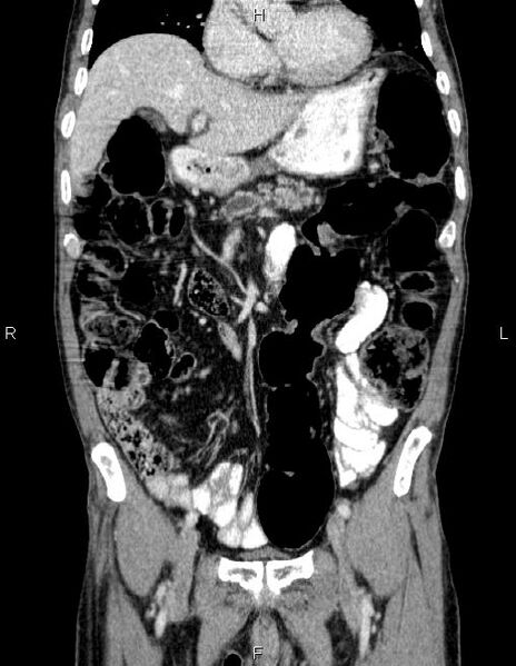 File:Ampullary adenocarcinoma (Radiopaedia 86093-102032 C 25).jpg