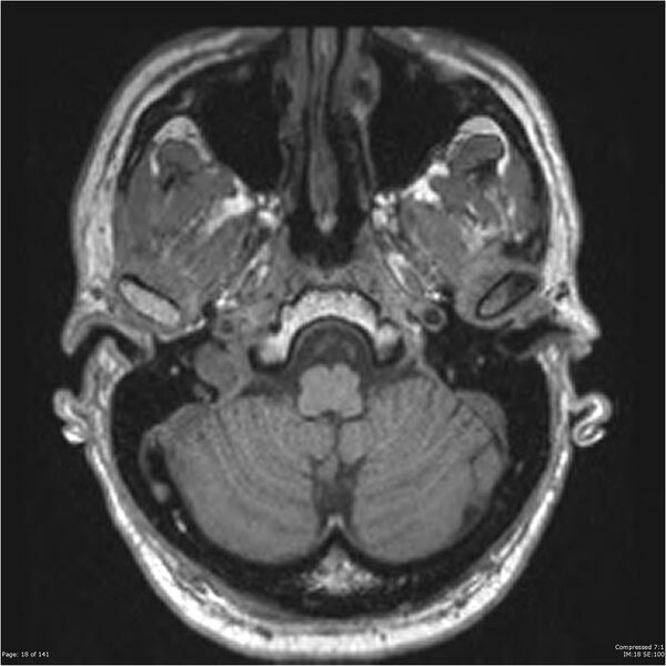 File:Anaplastic meningioma with recurrence (Radiopaedia 34452-35788 Axial T1 16).jpg