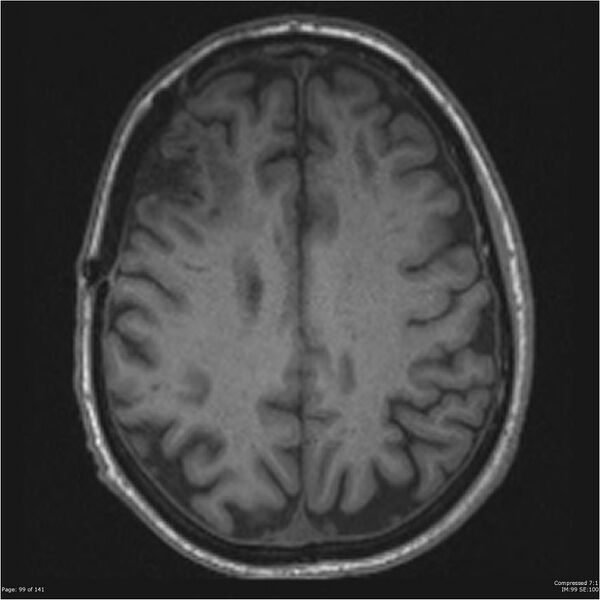 File:Anaplastic meningioma with recurrence (Radiopaedia 34452-35788 Axial T1 97).jpg