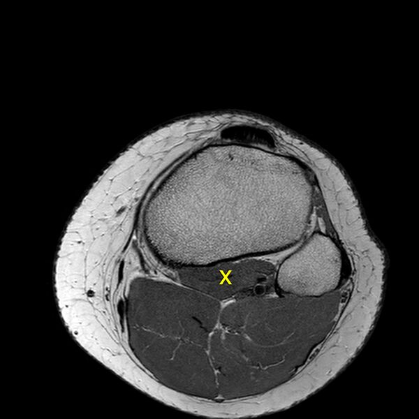 File:Anatomy Quiz (MRI knee) (Radiopaedia 43478-46866 A 25).jpeg