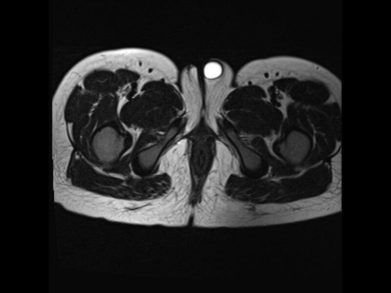 File:Androgen insensitivity syndrome (Radiopaedia 42046-45081 Axial T2 23).jpg