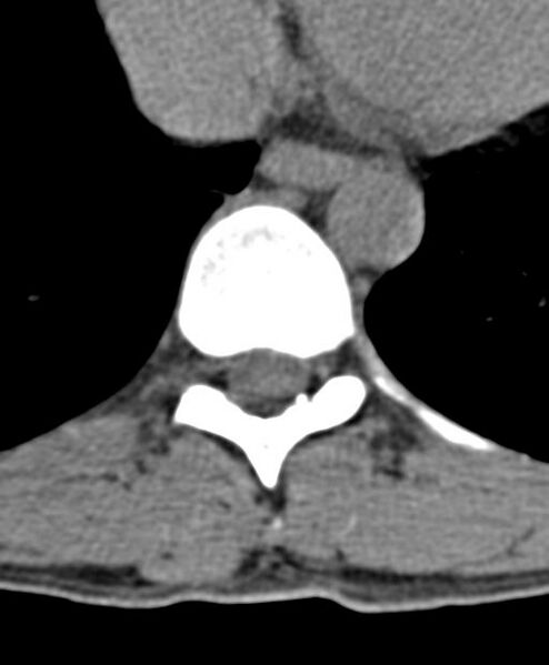 File:Aneurysmal bone cyst T11 (Radiopaedia 29294-29721 Axial non-contrast 26).jpg