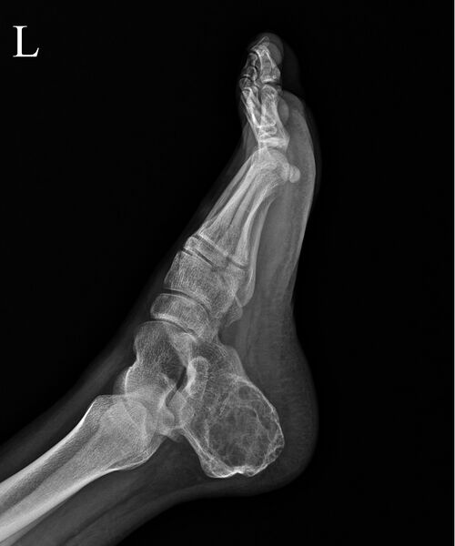 File:Aneurysmal bone cyst of the calcaneus (Radiopaedia 60669-68416 Lateral 1).jpg