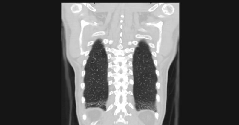 File:Angioinvasive aspergellosis (Radiopaedia 66995-76315 Coronal lung window 55).jpg