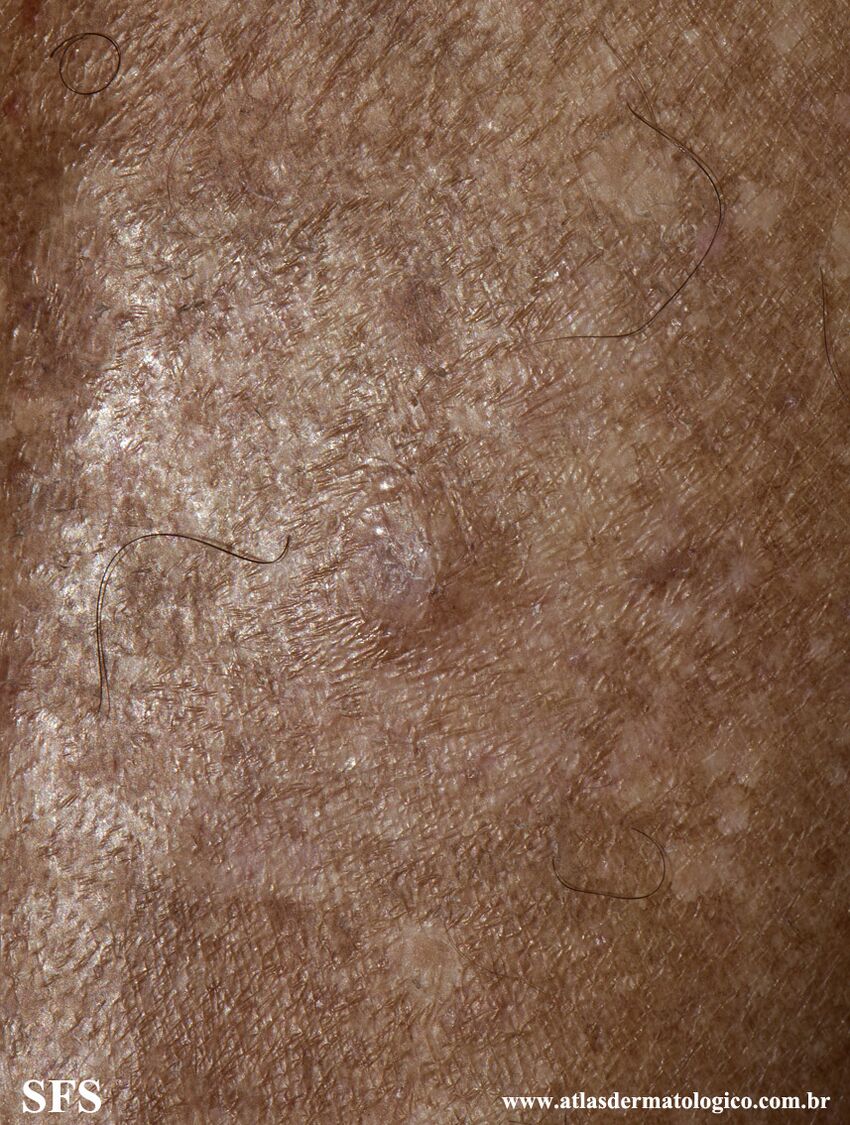 Angioleiomyoma (Dermatology Atlas 3).jpg