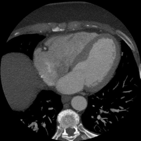 File:Anomalous origin of left circumflex artery from right coronary sinus (Radiopaedia 72563-83117 A 22).jpg