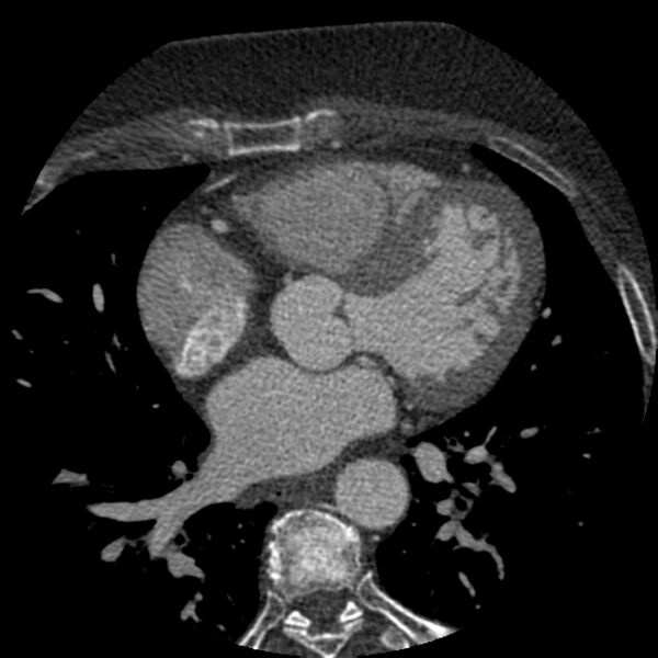 File:Anomalous origin of left circumflex artery from right coronary sinus (Radiopaedia 72563-83117 B 72).jpg