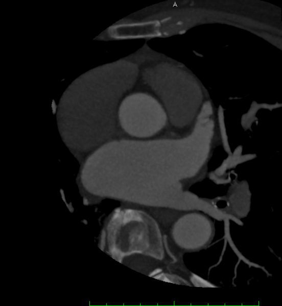 File:Anomalous origin of the circumflex artery with retro-aortic course (Radiopaedia 27974).png