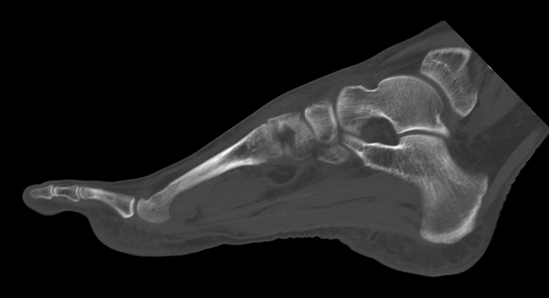 File:Anterior calcaneal process fracture (Radiopaedia 47384-51989 Sagittal bone window 17).png
