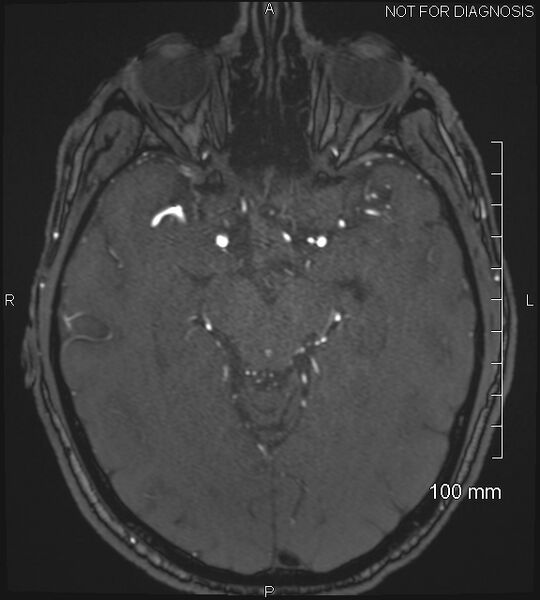 File:Anterior cerebral artery aneurysm (Radiopaedia 80683-94127 Axial MRA 99).jpg