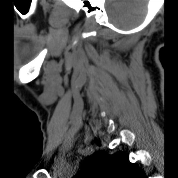 File:Anterior cervical postdiscectomy arthrodesis (Radiopaedia 32678-33646 C 39).jpg