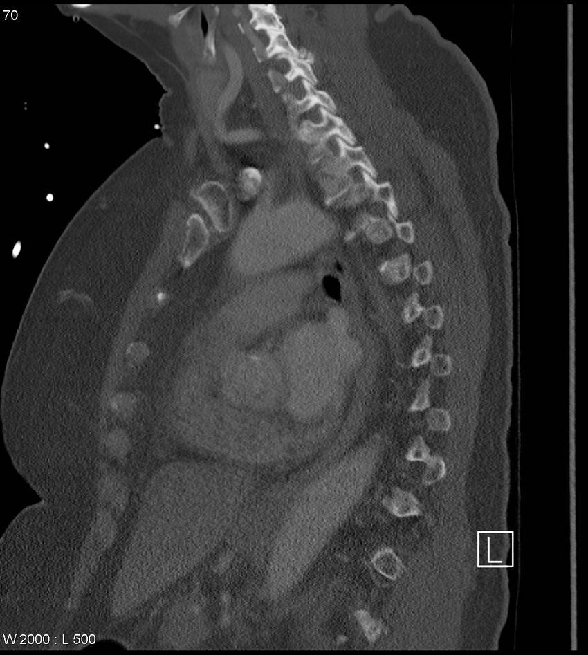 Anterior shoulder dislocation (CT) (Radiopaedia 59032-66309 Sagittal bone window 35).jpg