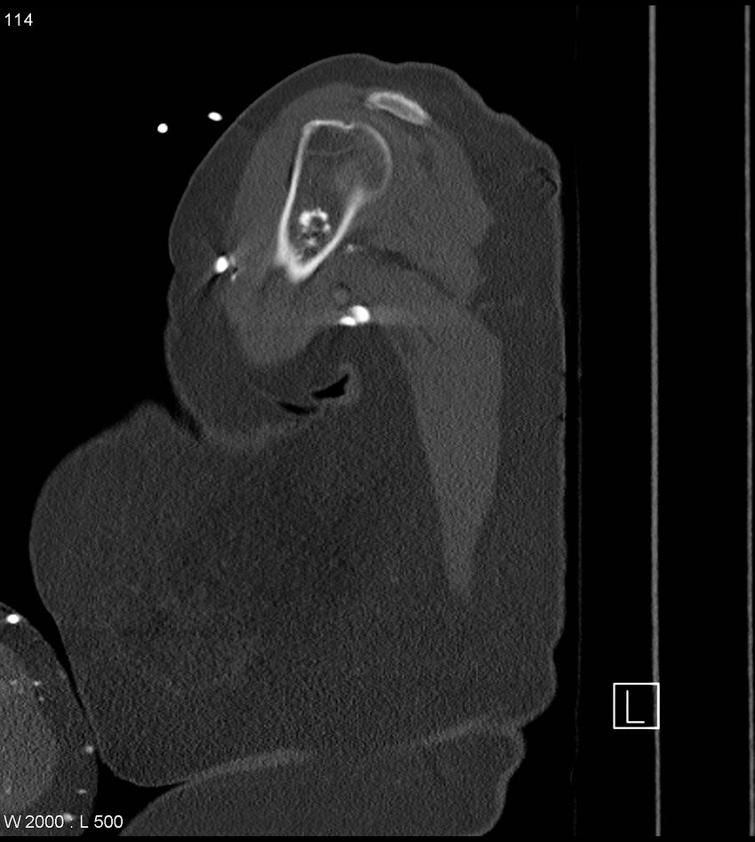 Anterior shoulder dislocation (CT) (Radiopaedia 59032-66309 Sagittal bone window 57).jpg
