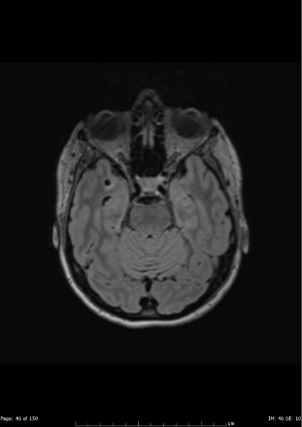 File:Anterior temporal lobe perivascular space (Radiopaedia 40946-43650 Axial FLAIR 7).jpg