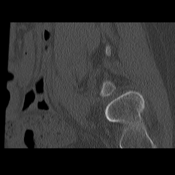 File:Anterolisthesis (Radiopaedia 22226-22263 Sagittal bone window 21).jpg