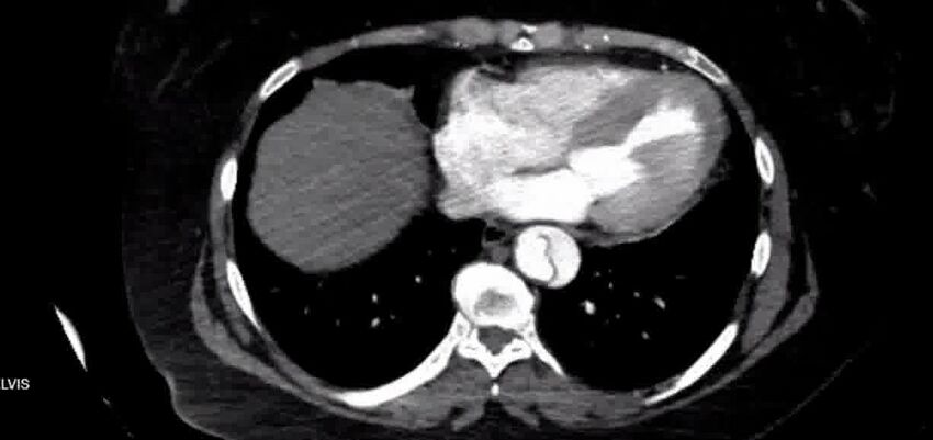 Aortic Dissection (Radiopaedia 85272-100847 A 33).jpg