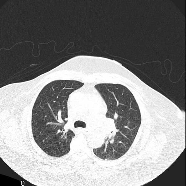 File:Aortic arch false aneurysm (Radiopaedia 14667-14587 Axial lung window 10).jpg