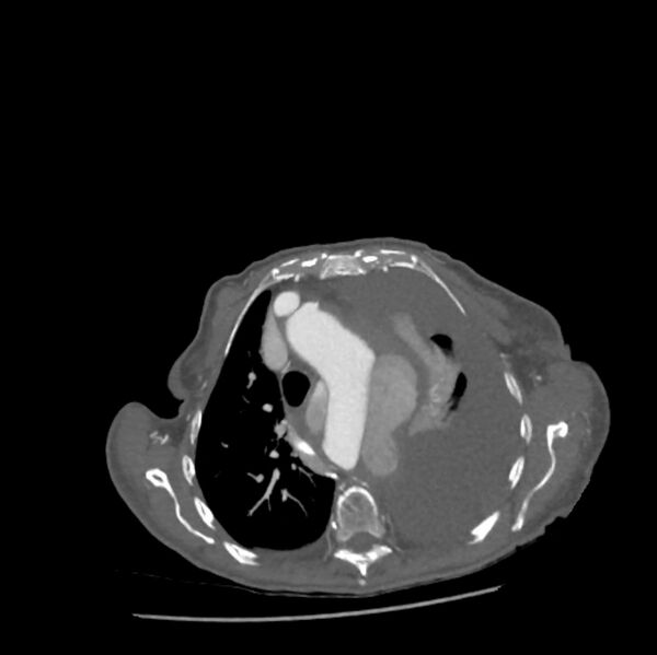 File:Aortic dissection (Radiopaedia 68763-78691 A 13).jpeg