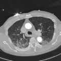 Aortic dissection - DeBakey type II (Radiopaedia 64302-73082 Axial lung window 22).png