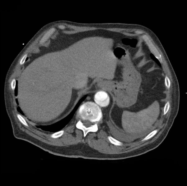 File:Aortic dissection with rupture into pericardium (Radiopaedia 12384-12647 A 48).jpg