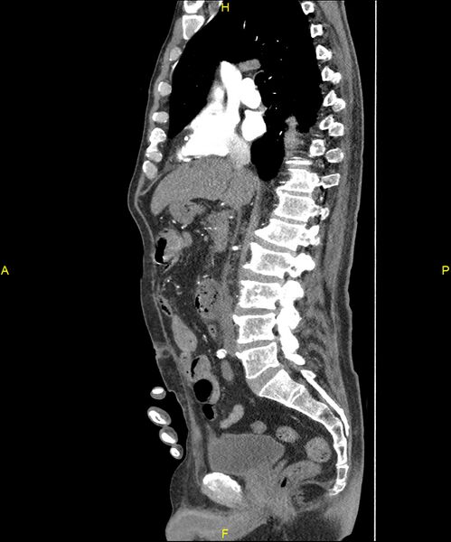 File:Aortoenteric fistula (Radiopaedia 84308-99603 C 158).jpg