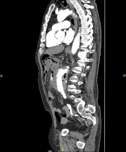 File:Aortoenteric fistula (Radiopaedia 84308-99603 C 199).jpg