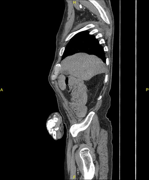 File:Aortoenteric fistula (Radiopaedia 84308-99603 C 53).jpg