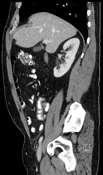 File:Appendiceal diverticulitis (Radiopaedia 61802-69816 C 80).jpg