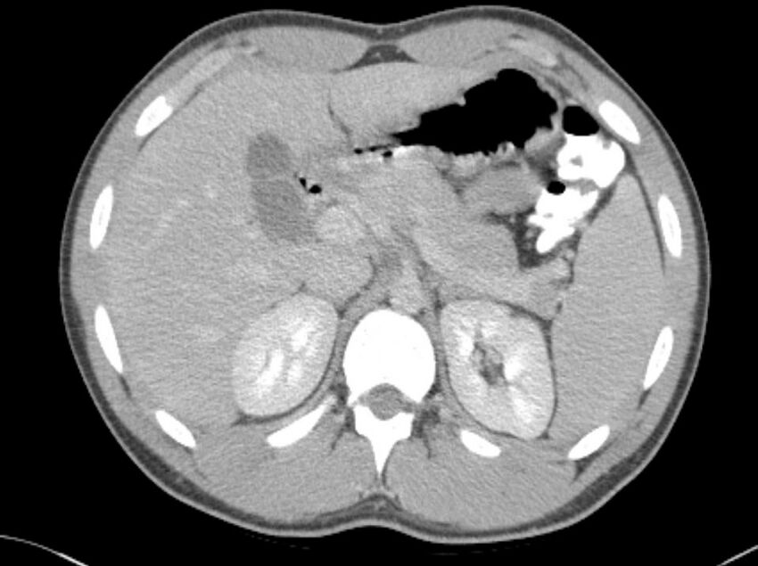 Appendicitis and incidental foregut duplication cyst (Radiopaedia 52962-58916 A 2).jpg