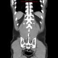 Appendicitis and renal cell carcinoma (Radiopaedia 17063-16760 B 26).jpg