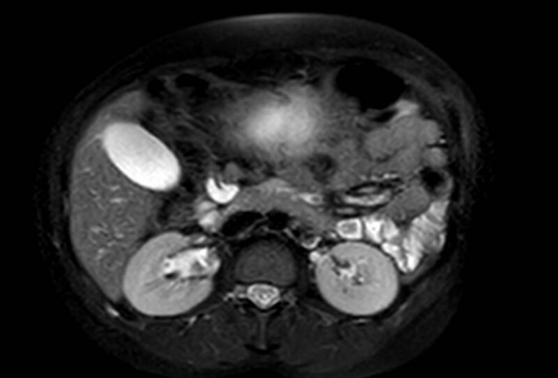 File:Appendicitis in gravida (MRI) (Radiopaedia 89433-106395 Axial T2 SPAIR 29).jpg