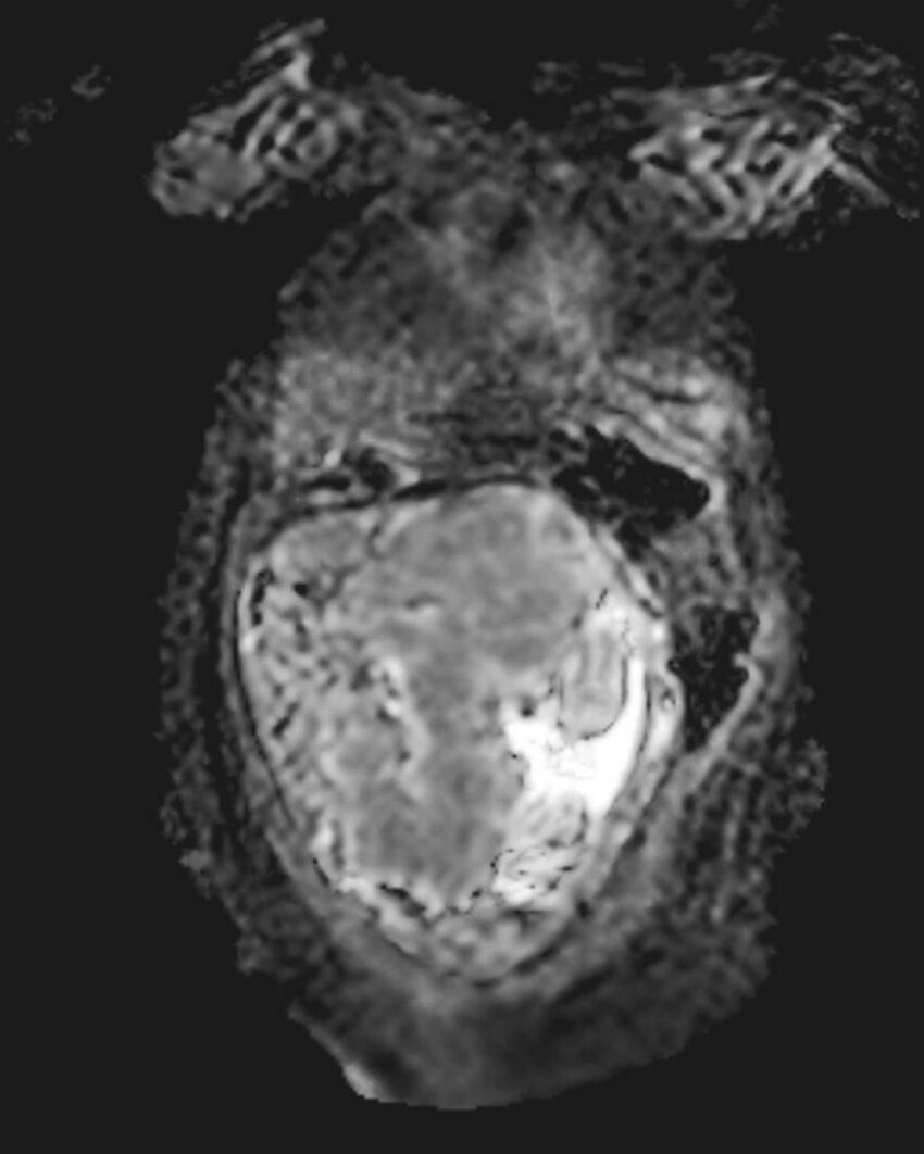 Appendicitis in gravida (MRI) (Radiopaedia 89433-106395 Coronal ADC 12).jpg