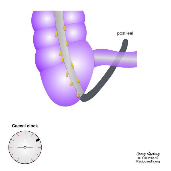 File:Appendix position (diagram) (Radiopaedia 62911-71293 C 3).jpeg