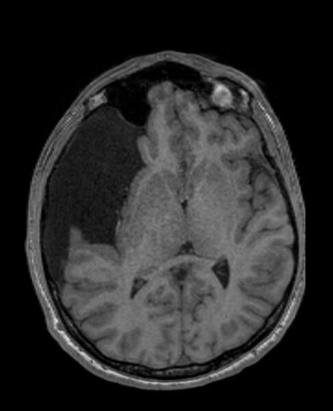 File:Arachnoid cyst- extremely large (Radiopaedia 68741-78451 Axial T1 39).jpg