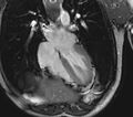 Arrhythmogenic right ventricular cardiomyopathy (Radiopaedia 39806-42237 D 87).jpg